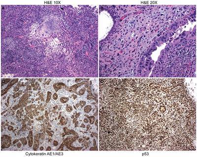 Gemcitabine combination therapies induce apoptosis in uterine carcinosarcoma patient-derived organoids